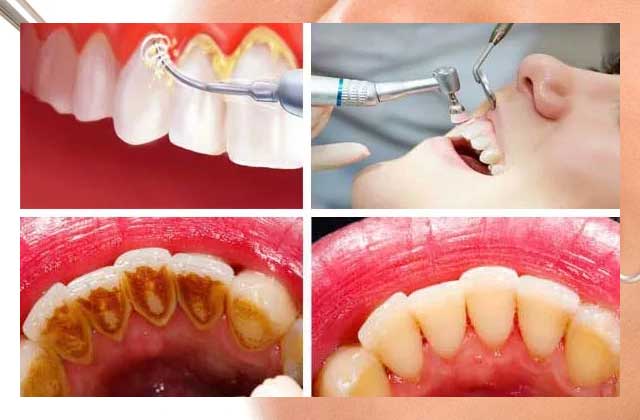 8 Cara Membersihkan Karang Gigi Dengan Tepat Dan Aman